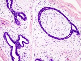 Breast cancer (fibroadenoma) which has infiltrated the duct (large purple regular or irregular circles), by KGH at Wikimedia